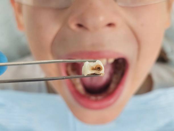 Best Emergency Root Canal Treatment in Merrillville, IN